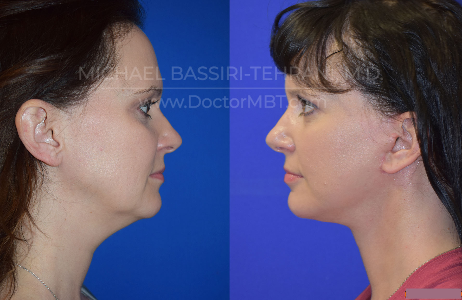 Dr. Michael Bassiri-Tehrani - Facelift Patient