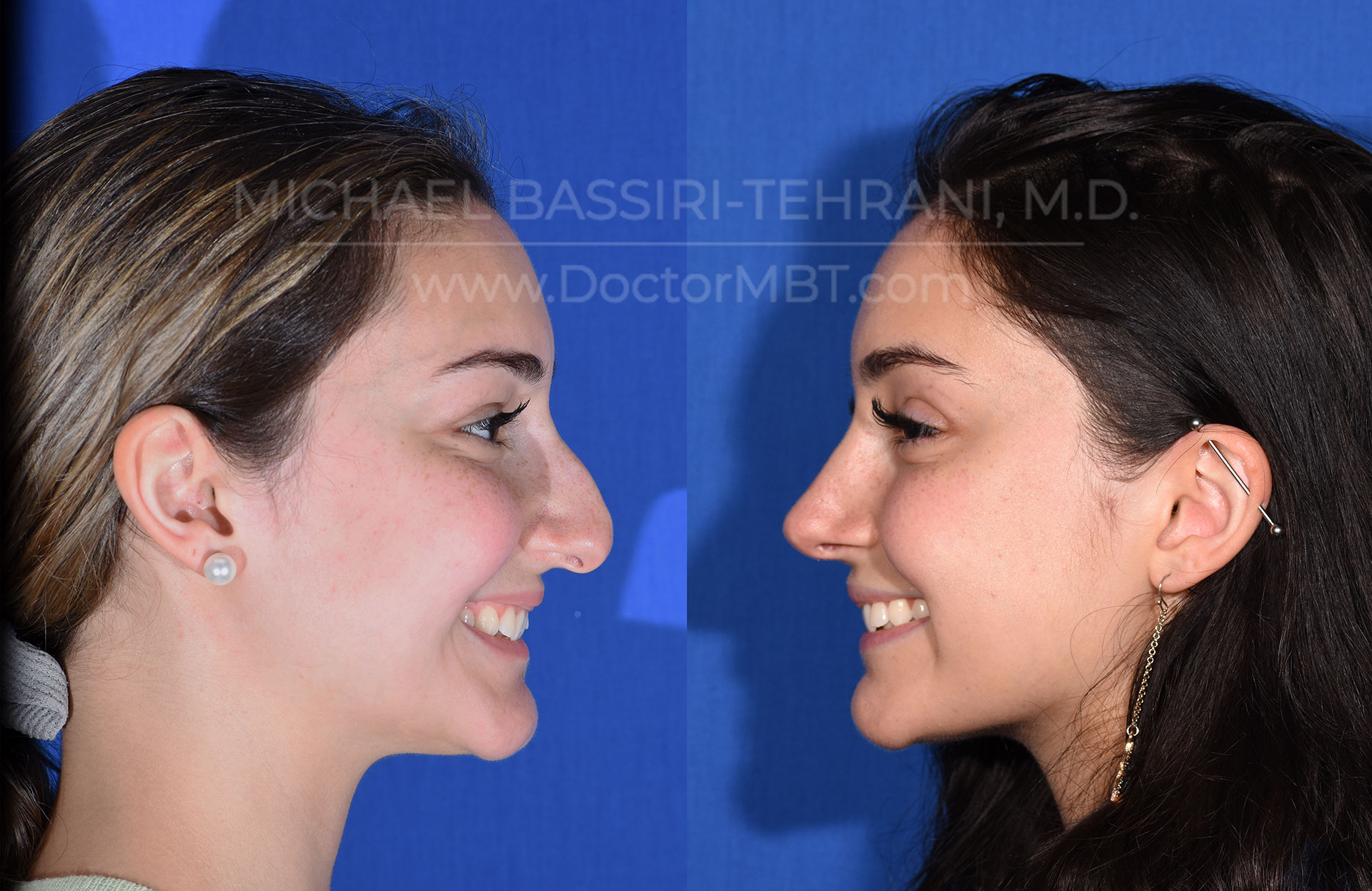 Dr. Michael Bassiri-Tehrani - Rhinoplasty Patient