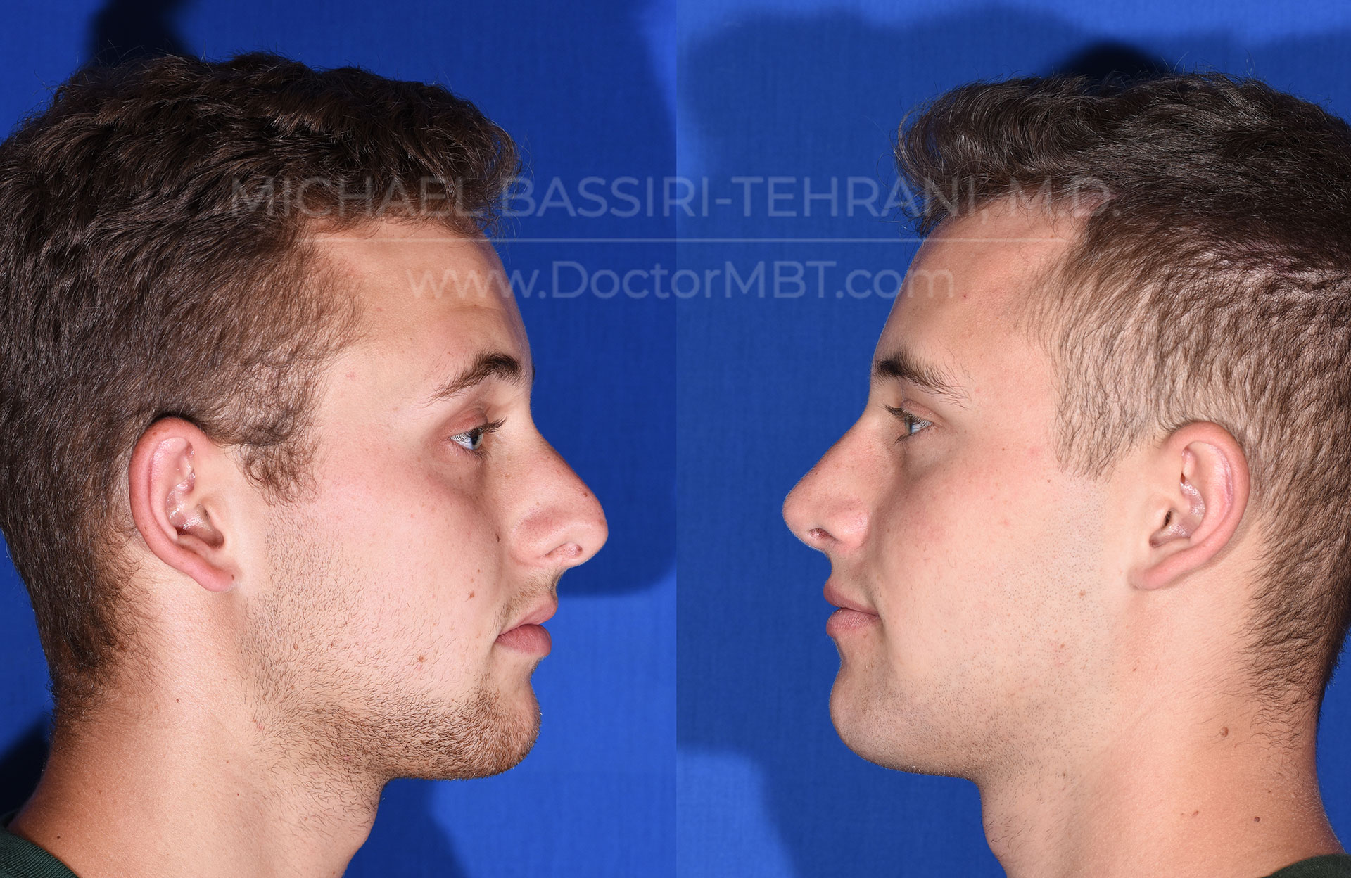 Dr. Michael Bassiri-Tehrani - Rhinoplasty Patient