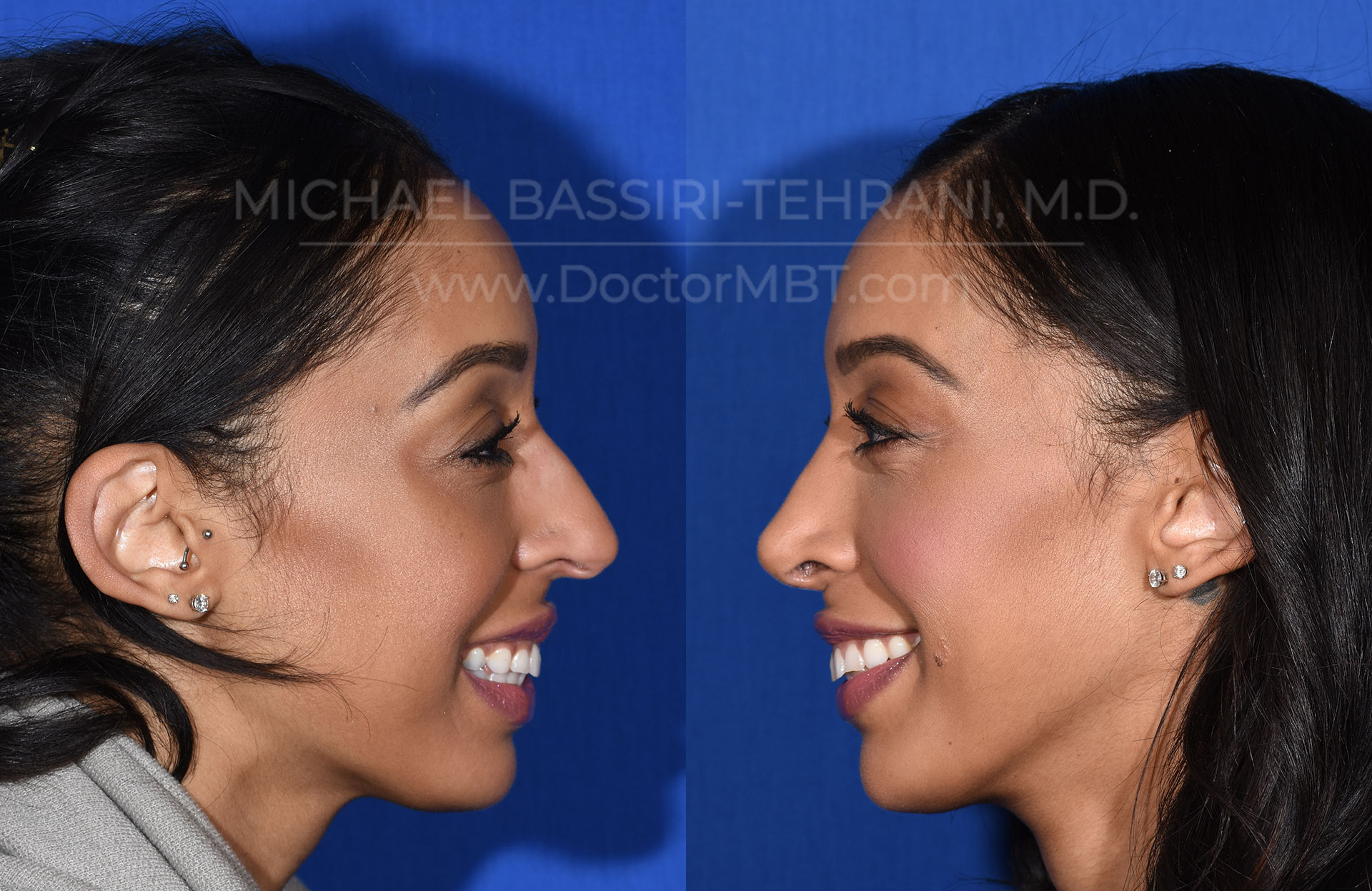 Dr. Michael Bassiri-Tehrani - Rhinoplasty Patient